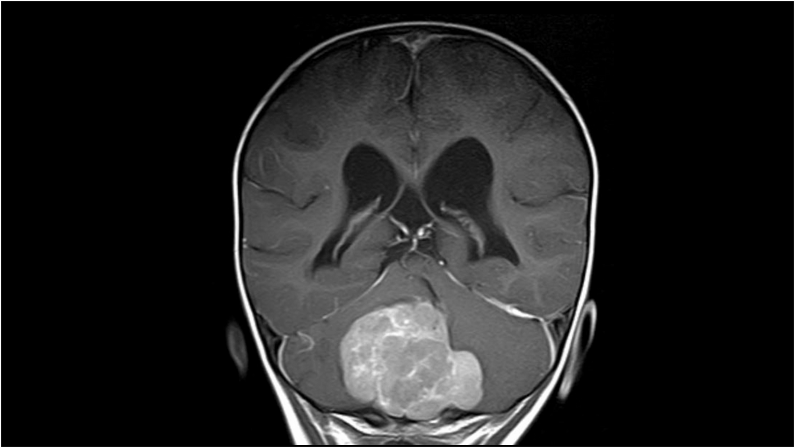 Childhood brain tumors develop early in highly specialized nerve cells