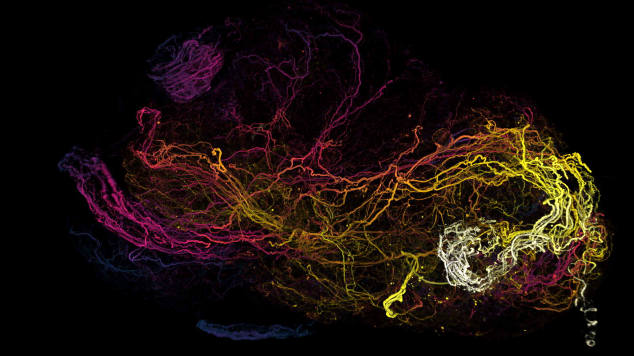 Pancreatic Cancer: Interactions between Neurons and Tumor
