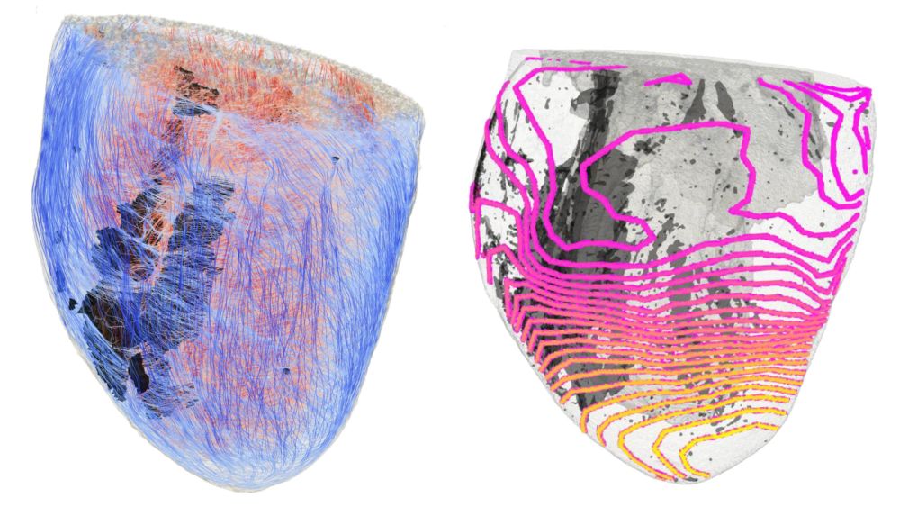 How Fibrosis Disrupts the Heart’s Electrical Signals