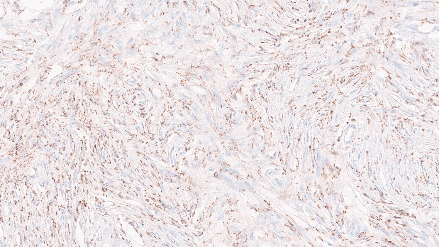Risk of recurrence in meningiomas: Not only tumor cells, but also their “neighbors” are taken into account in molecular classification.