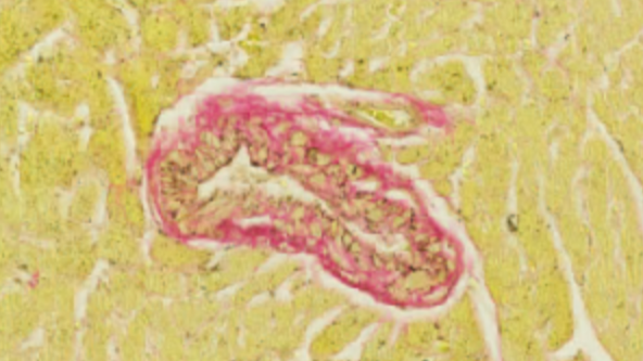 How cancer immunotherapies affect the heart