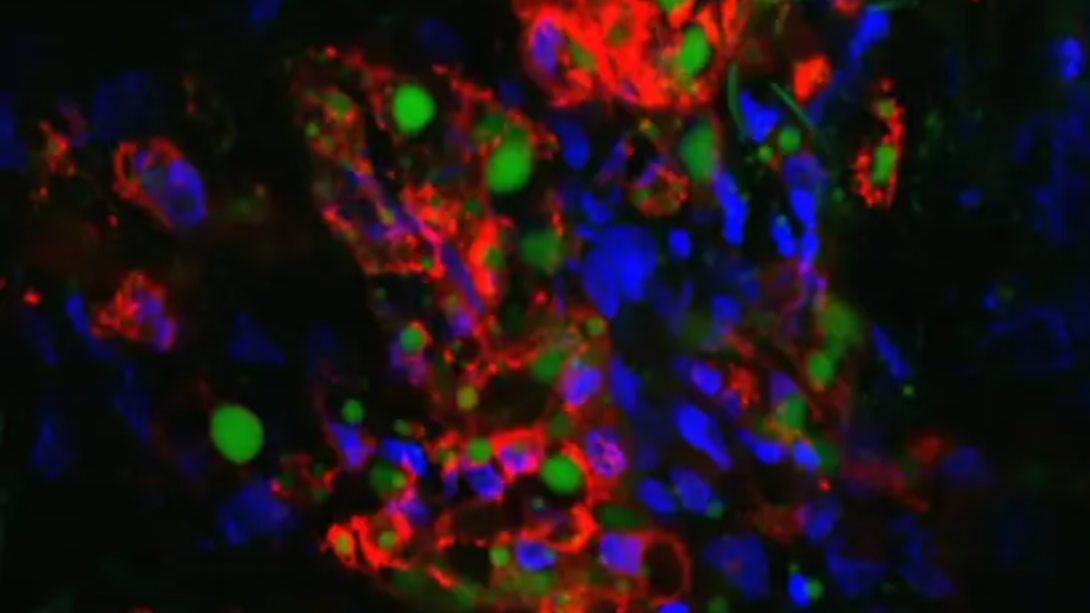 Ovarian Cancer: Adipose Tissue Influences the Efficacy of Immunotherapy