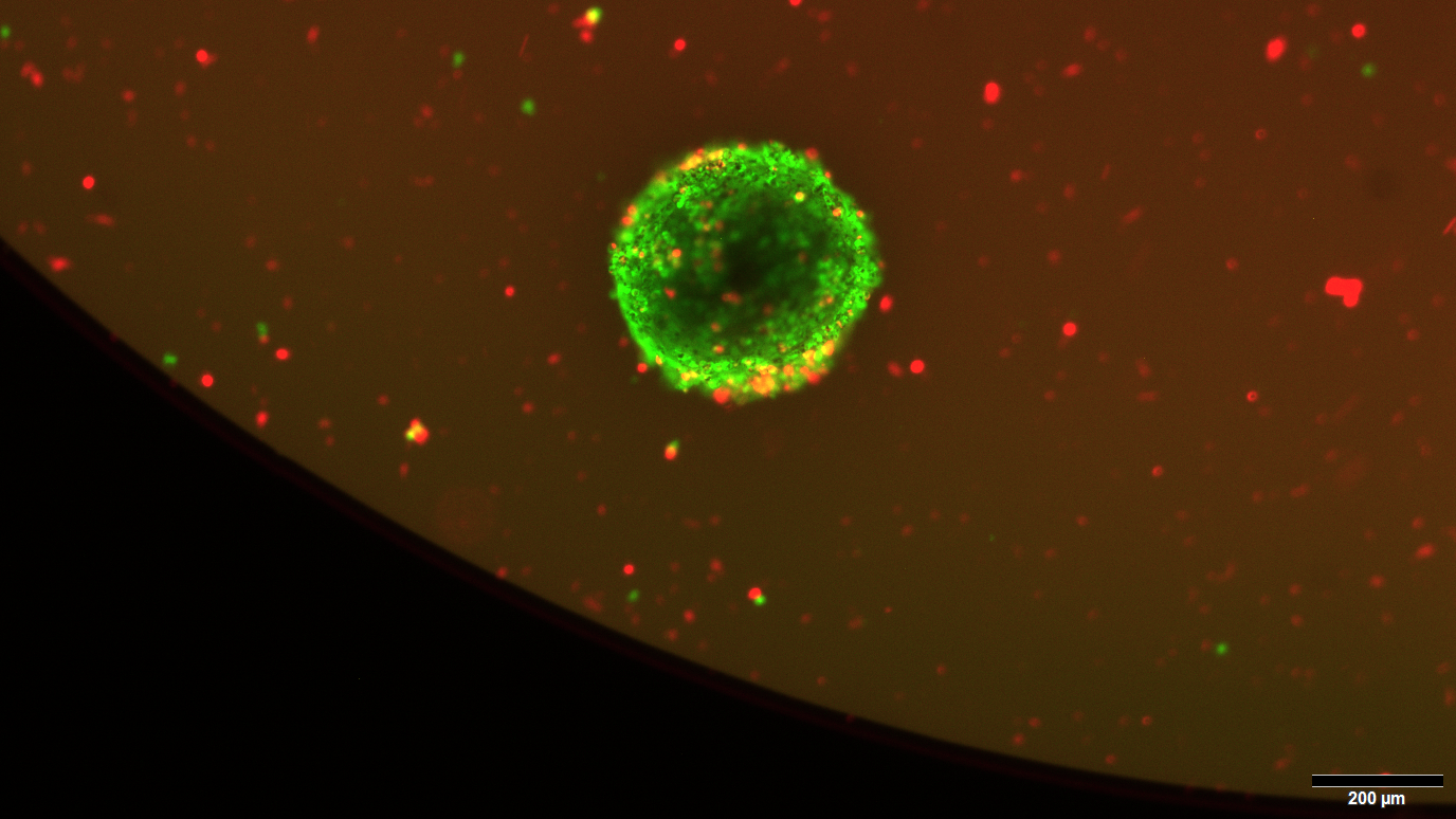 High-throughput testing of drugs on mini-tumors reveals vulnerabilities in meningiomas