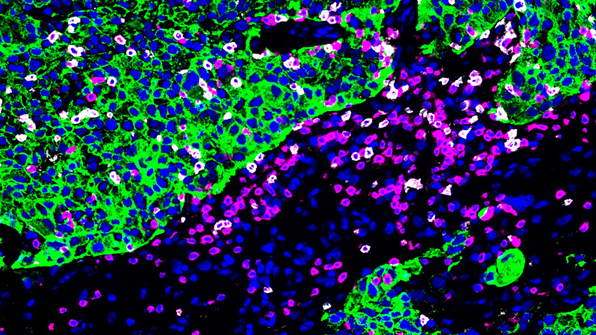 Brain metastases from breast cancer: Immune cell patterns could improve treatment decisions