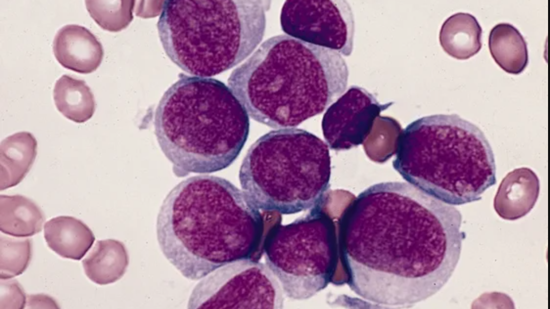 Leukemia stem cells cause treatments to fail – Findings open new avenues to overcome resistance
