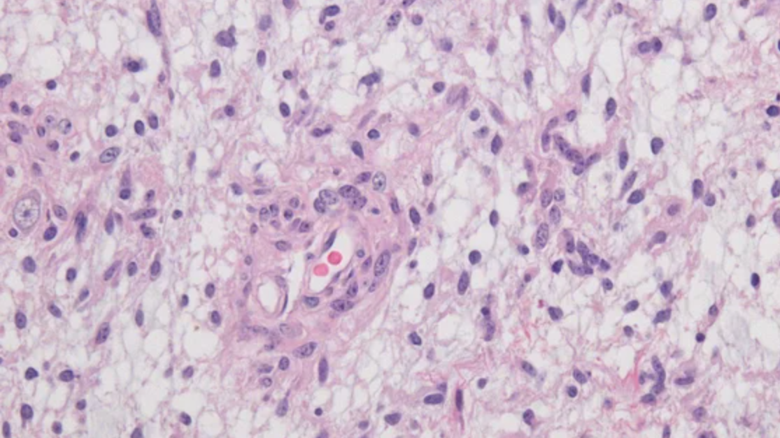AI Diagnoses Brain Tumors in Minutes Instead of Weeks