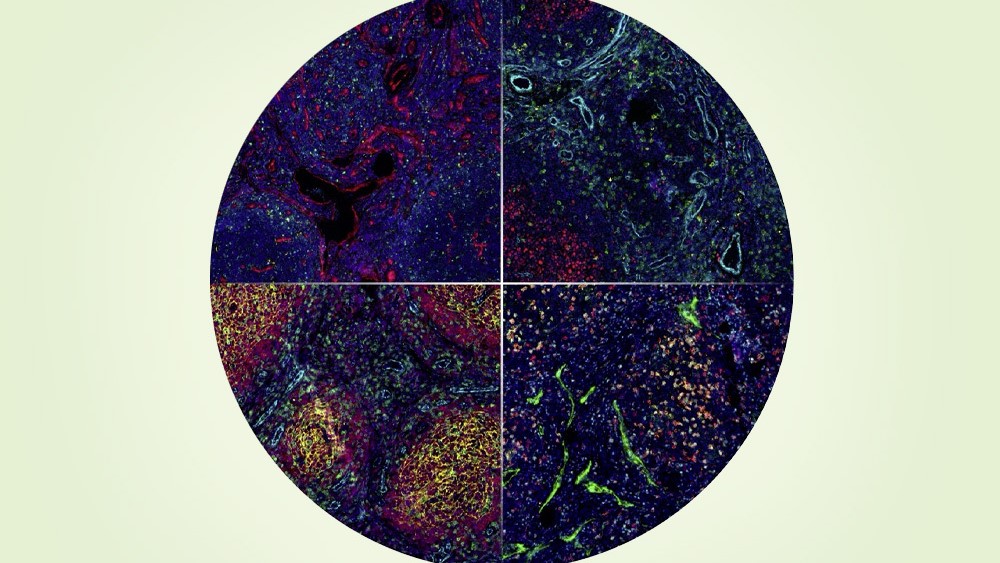 New software helps researchers decode the cellular architecture of lymphoma