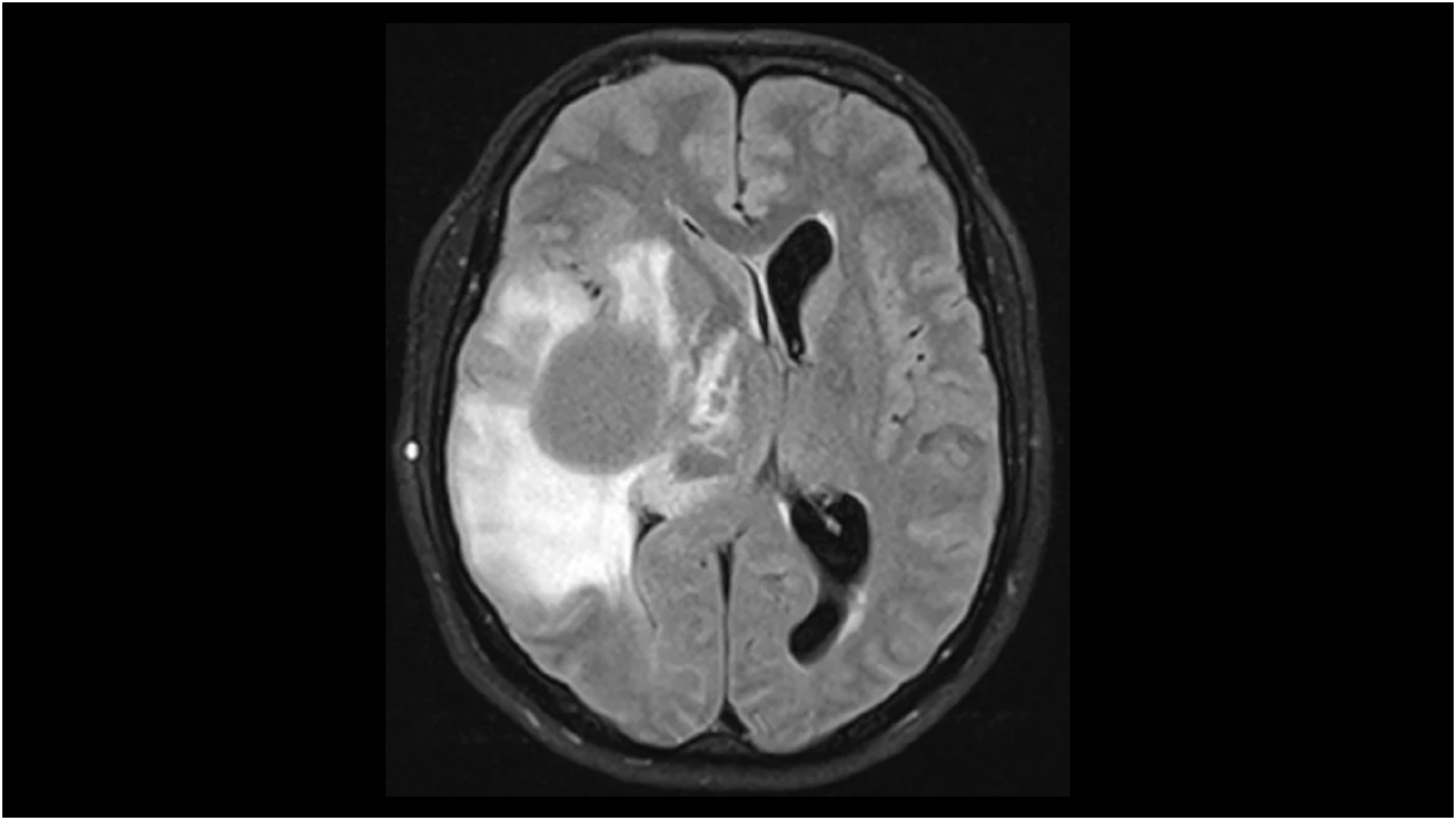 Vaccine Against Brain Tumors Shows Promising Long-Term Results