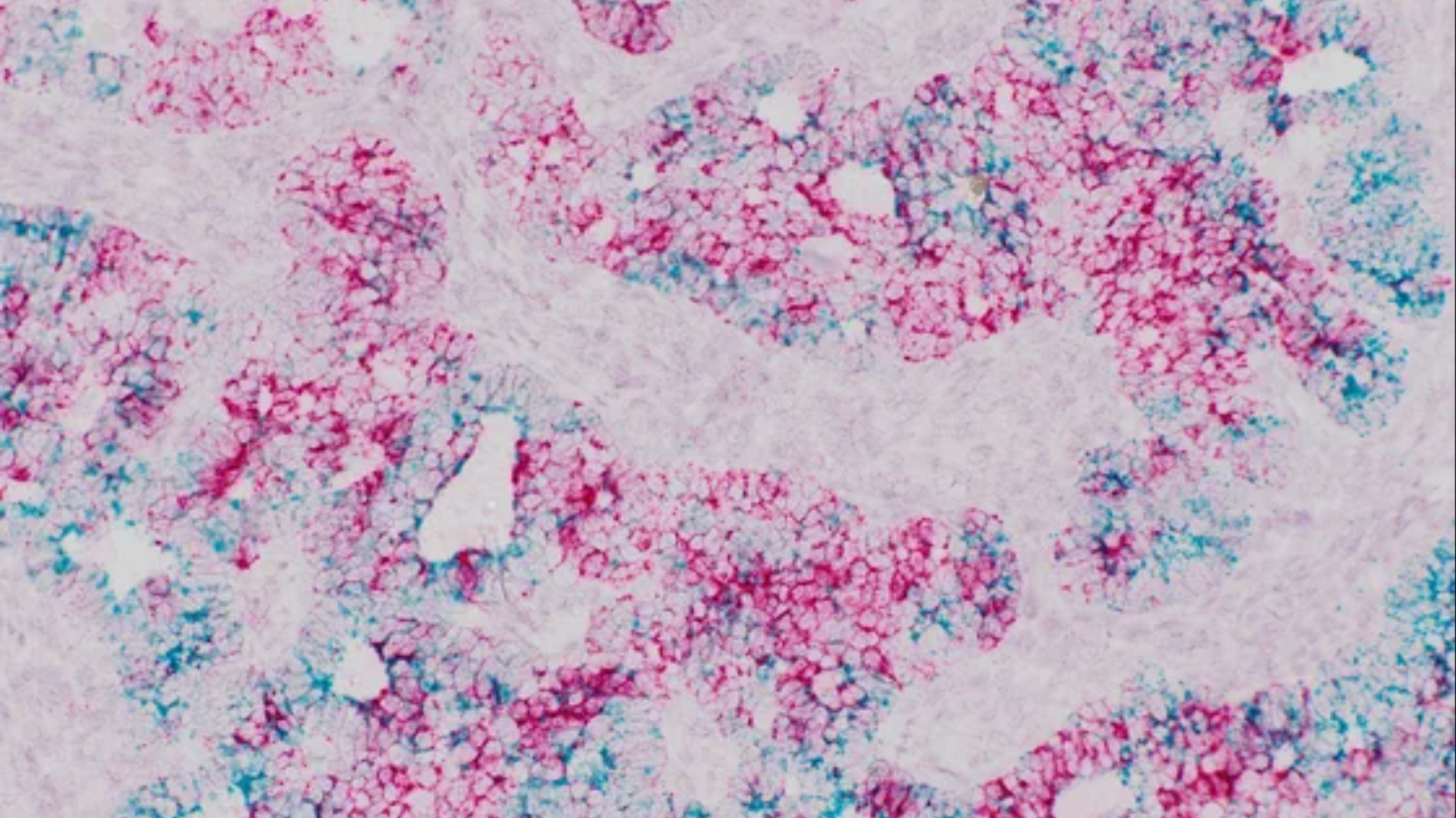 Newly Discovered Marker for Metastatic Colorectal Cancer Is the Achilles’ Heel of Highly Aggressive Tumor Cells