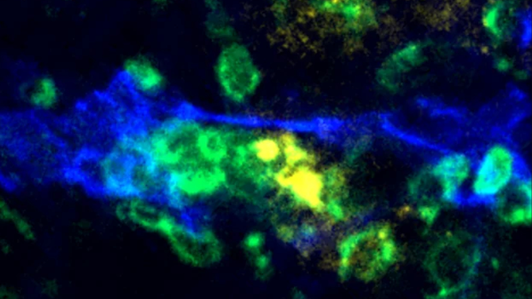 Blood vessels guide immune cells to metastases