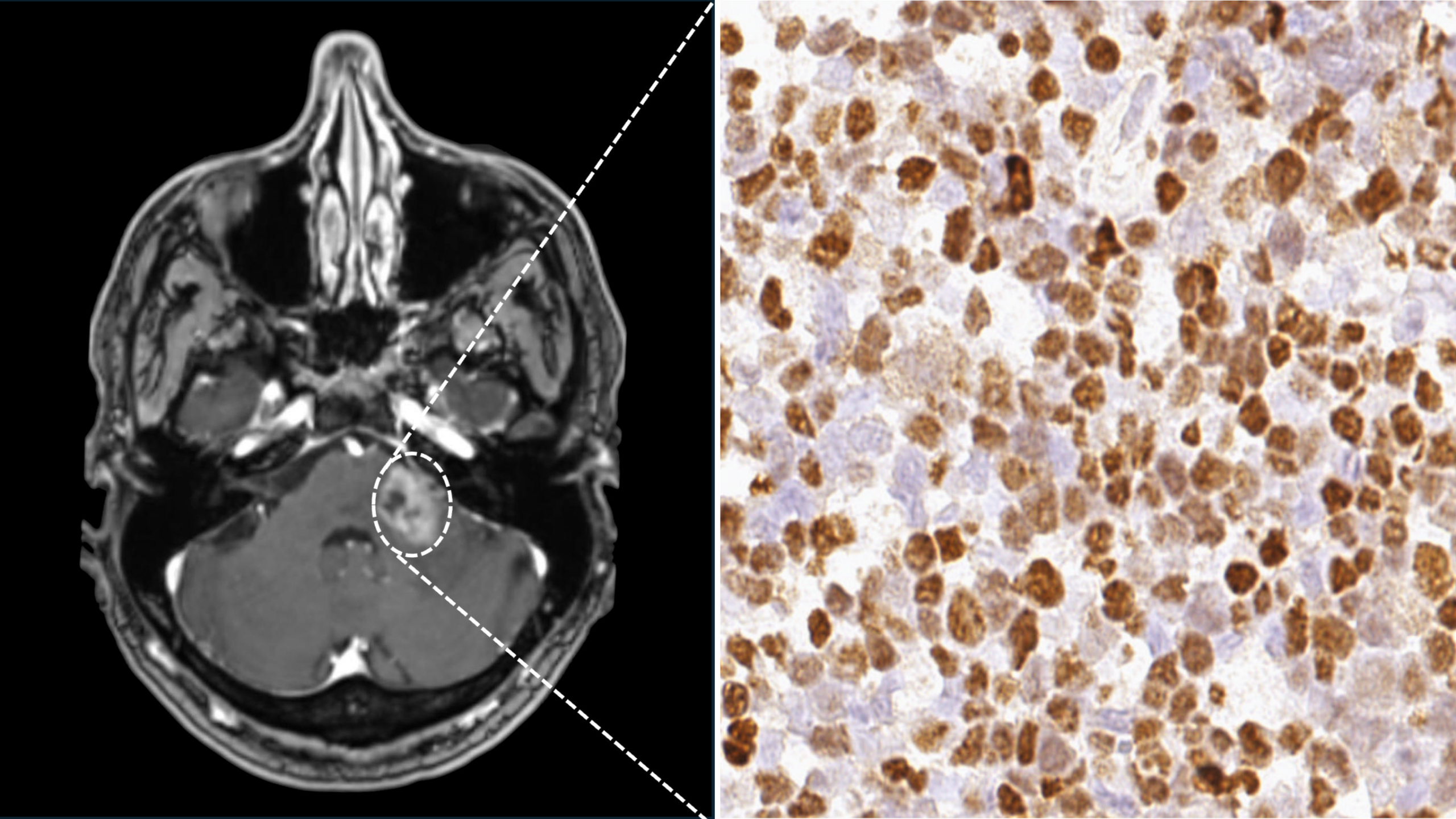 Virus influences rare brain lymphomas