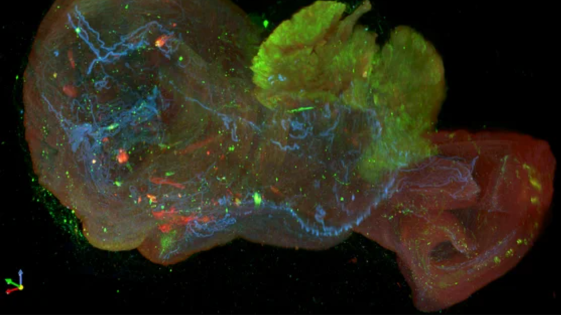 Colon Cancer: How Highly Aggressive Tumors Evade the Immune System
